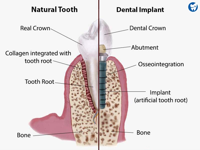 Natural Tooth vs Implant