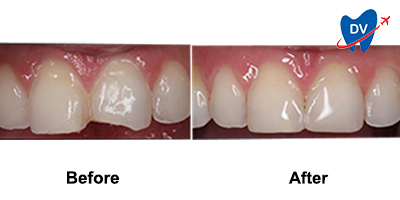 Tooth Crowns in Costa Rica Before & After
