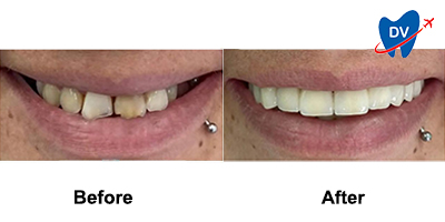 Tooth Crowns in Croatia Before & After