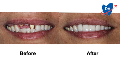 Dental Implants in Albania Before & After