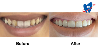 Dental Work in Puerto Rico Before & After