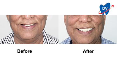 All-on-4 Dental Implants in Hyderabad Before & After