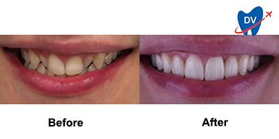 Before & After: Smile Makeover in Sofia