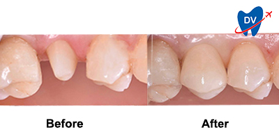 Before & After Image of Dental Crowns