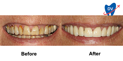 Before & After: Dental Veneers in Puerto Vallarta