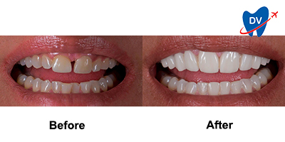 Before & After: Emax Veneers in Cancun