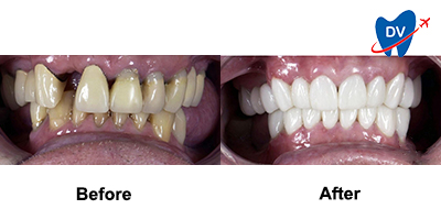 Before & After: Hollywood Smile in San Jose del Cabo