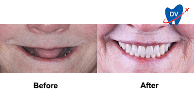 Before & After: Implant Dentures in Los Algodones