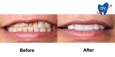 Before & After: Smile Makeover in Nogales