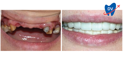 Before & After: Dental Implants in Istanbul