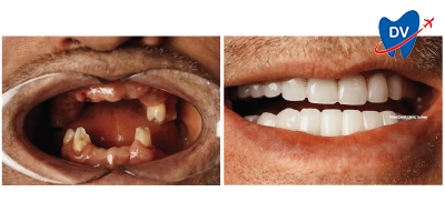 Before & After: Dental Implants in Izmir