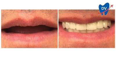 Before & After: Dental Implants in Tekirdag