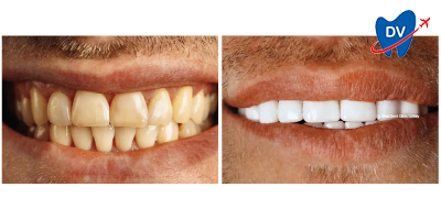 Before & After: Teeth Whitening in Izmir