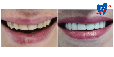 Before & After: Teeth Whitening in Tirana